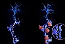 Avances en Esclerosis Múltiple: Descubrimiento Genético Revoluciona Diagnóstico y Tratamiento esclerosis múltiple