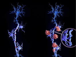 Avances en Esclerosis Múltiple: Descubrimiento Genético Revoluciona Diagnóstico y Tratamiento esclerosis múltiple