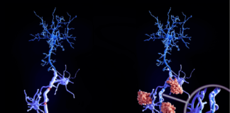 Avances en Esclerosis Múltiple: Descubrimiento Genético Revoluciona Diagnóstico y Tratamiento esclerosis múltiple