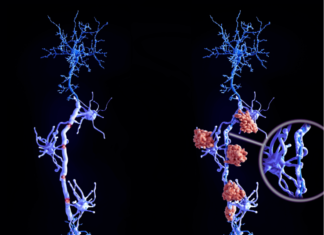 Avances en Esclerosis Múltiple: Descubrimiento Genético Revoluciona Diagnóstico y Tratamiento esclerosis múltiple