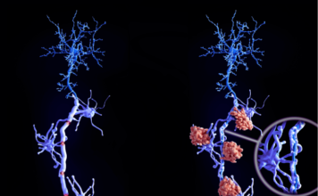 Avances en Esclerosis Múltiple: Descubrimiento Genético Revoluciona Diagnóstico y Tratamiento esclerosis múltiple