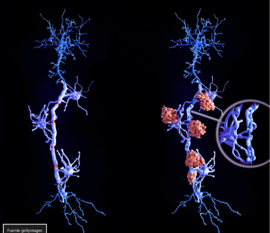 Avances en Esclerosis Múltiple: Descubrimiento Genético Revoluciona Diagnóstico y Tratamiento esclerosis múltiple